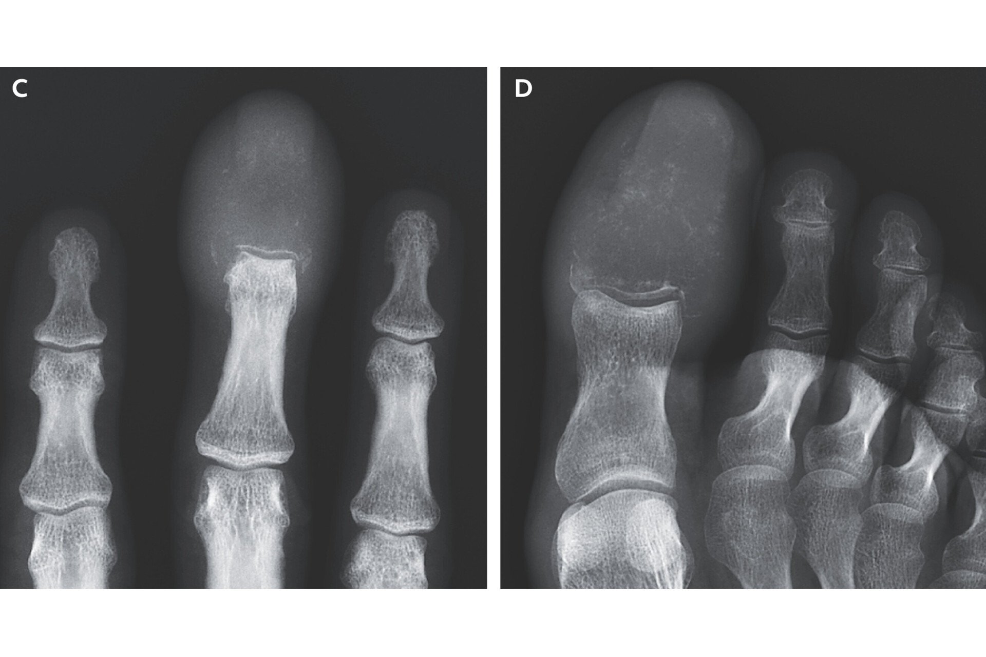 Rare Bone-Eating Cancer Replaced Man’s Finger and Toe