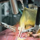 Zukunft der Medizin: Autonomer Roboter entfernt Gallenblasen