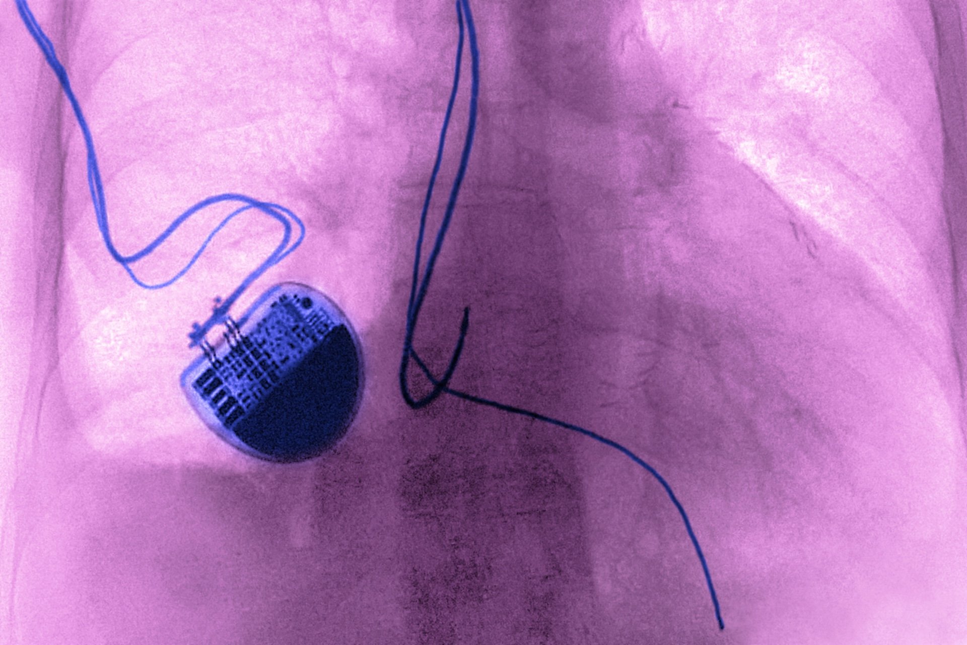 Death Row Inmate’s Attorneys Say Heart Implant Will Repeatedly Shock Him as He’s Executed