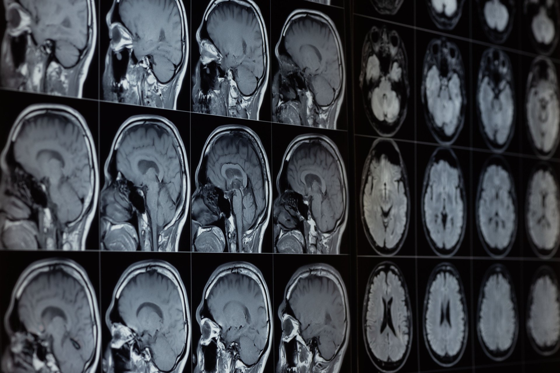 Our Brains Contain Lithium—and Its Loss Might Help Drive Alzheimer’s, Study Finds