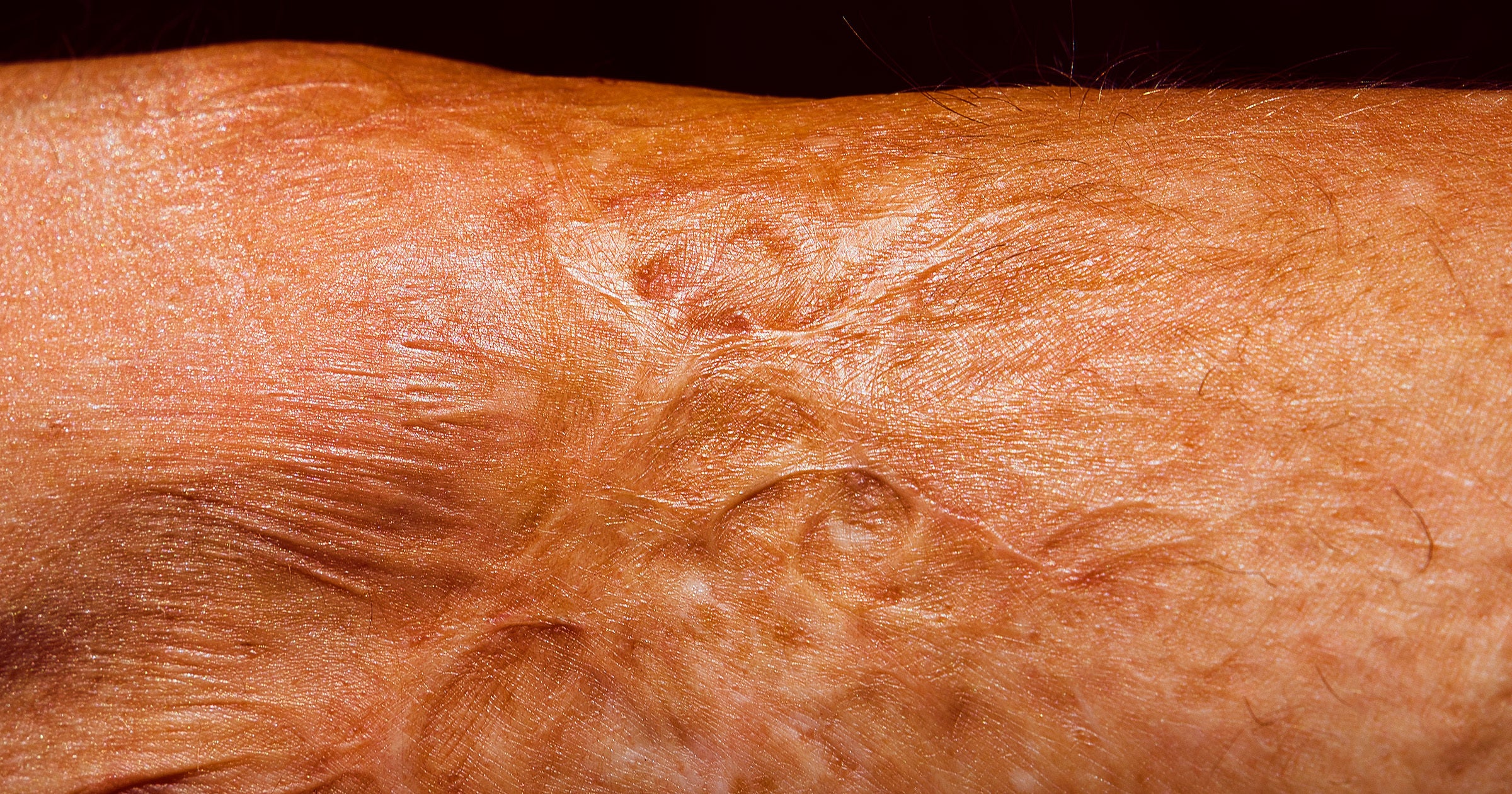 Scientists Intrigued by Cream Designed to Make Old Scars Disappear