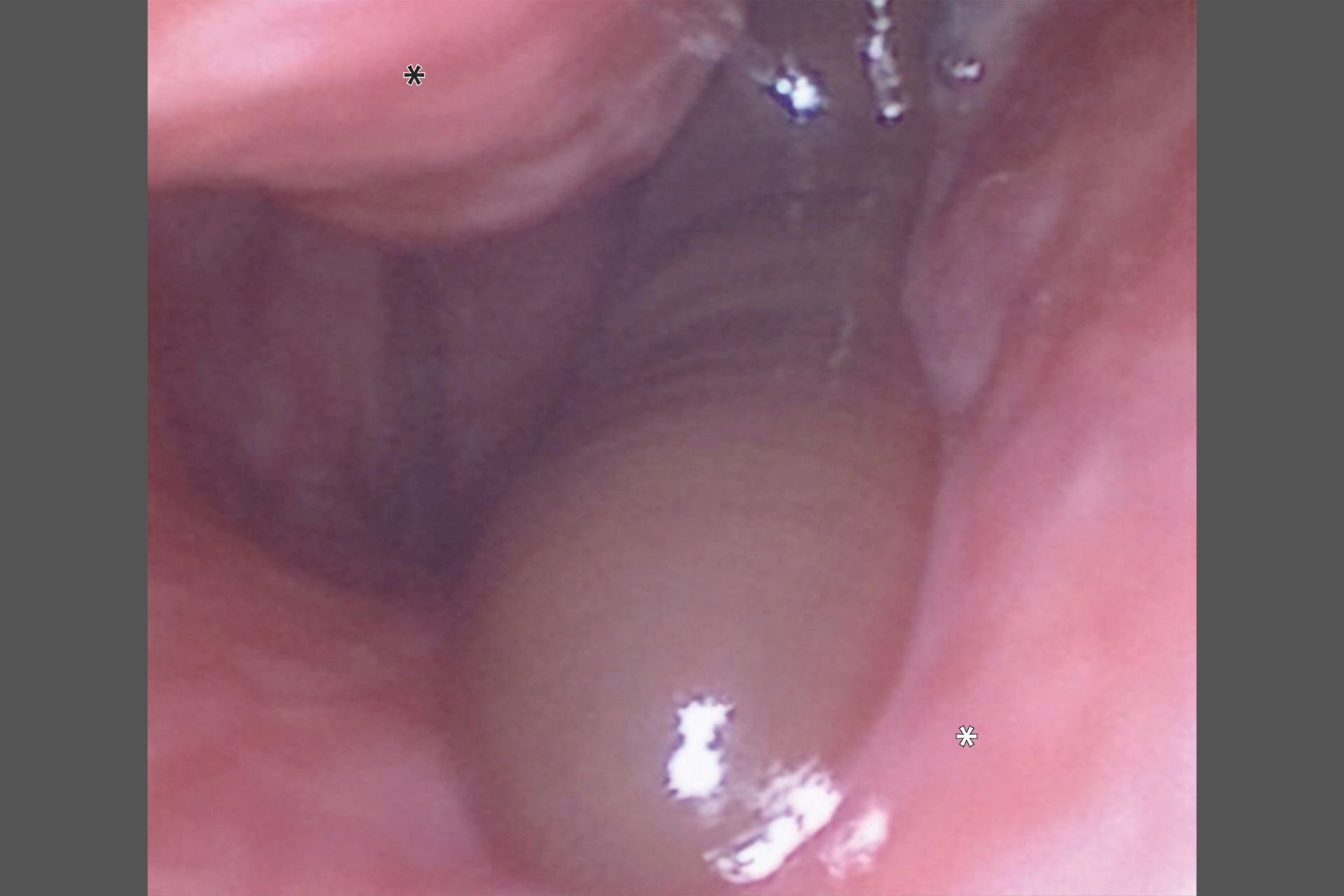 A Refreshing Mountain Rinse Left This Man With a Nose Leech and Days of Bleeding