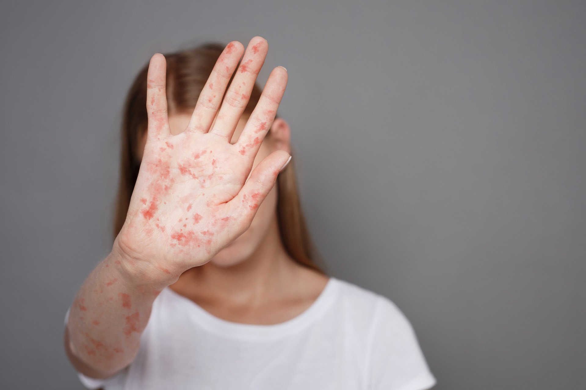 The Ongoing Measles Outbreak Has Reached a New Peak