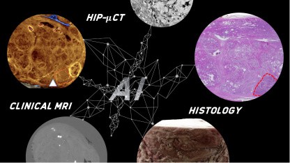 Forschung: Wie KI beim häufigsten Männerkrebs helfen soll