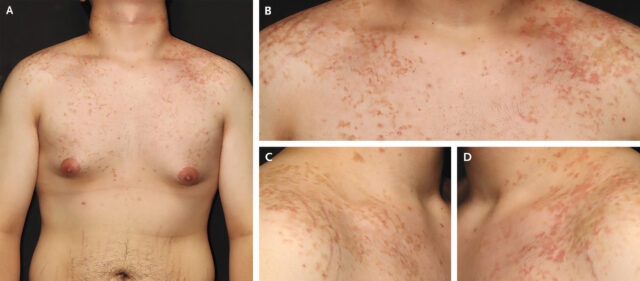 A weird, itchy rash is linked to the keto diet—but no one knows why