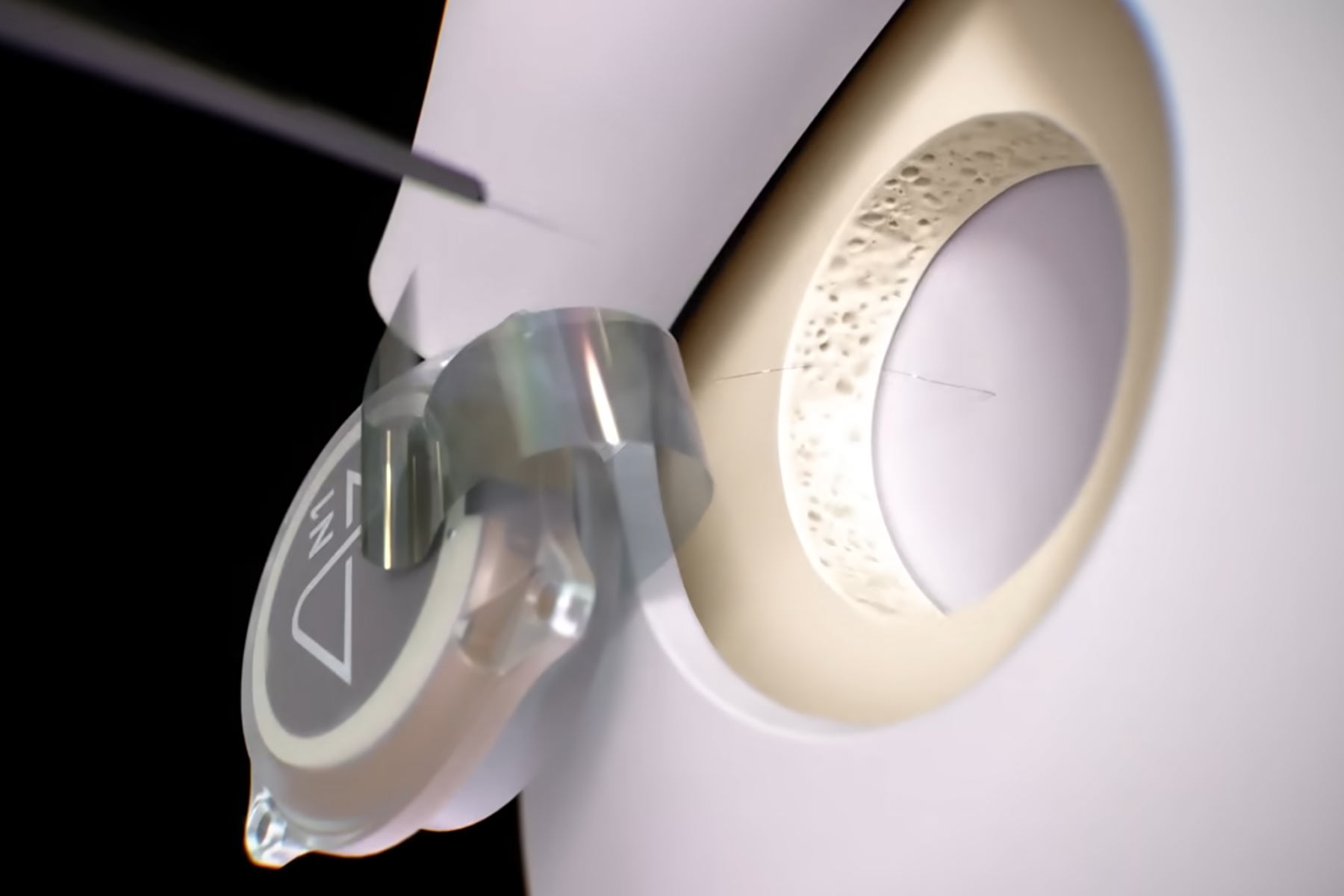 Elon Musk’s Brain-chip Startup Aims for Scalability with New Transdural Procedure