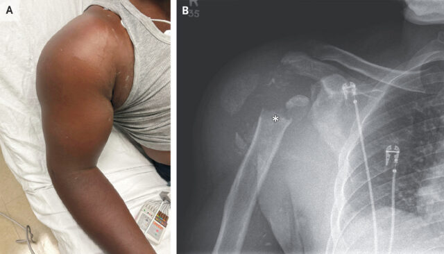 Doctors took a look at man’s painful shoulder—they found the joint was missing