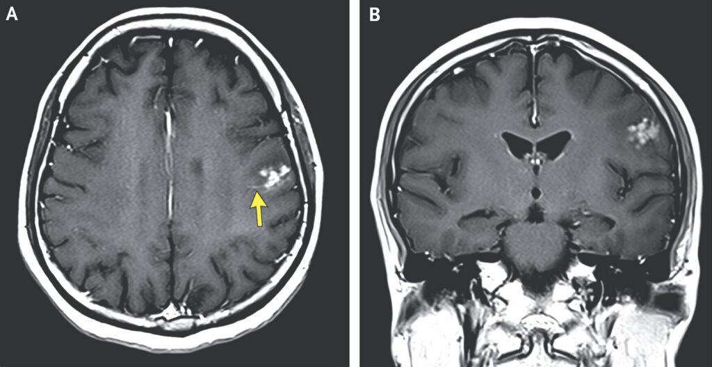 Woman’s brain worm infection confirmed after eggs grow tails in lab test